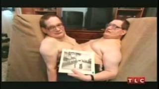 World's Oldest Conjoined Twins, Ronnie & Donnie Galyon