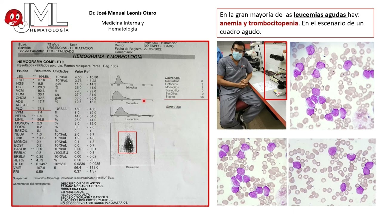 ASPIRADO DE MÉDULA ÓSEA Y CITOMETRIA DE FLUJO EN EL DIAGNÓSTICO DE LEUCEMIA AGUDA.