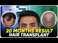 Hair transplant in bhubaneswar  best results  cost of hair transplant in bhubaneswar