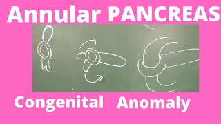 Annular pancreas | Congenital anomaly of pancreas | Embryology of Pancreas| easy to write in exams|