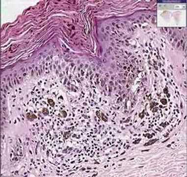 Video: Nevus Intradermal: Tanda, Gambar, Rawatan, Penyebab Penampilan