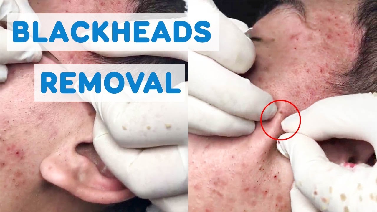 BLACKHEADS REMOVAL ON FACE YouTube