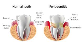 McCarl Dental Group Investigates: Signs of Gum Disease by McCarl Dental Group at Shipley's Choice, PC 22,456 views 6 years ago 1 minute, 35 seconds