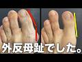 坐骨神経痛とお尻の奥の痛みは、「外反母趾」を整えると消えてなくなります。