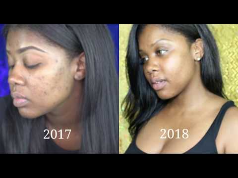 How To | Remove ACNE SCARS | DARK SPOTS