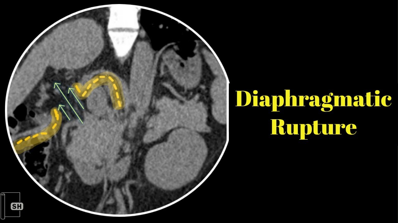Spontaneous Diaphragmatic Rupture/Hernia YouTube
