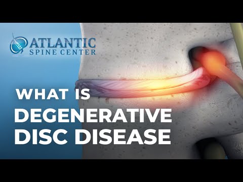 Video: Hva er discovertebral degenerasjon?