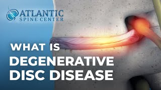 What Is Lumbar Degenerative Disc Disease? | Intervertebral Disc Height Loss screenshot 5