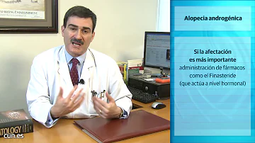 ¿Dónde suele empezar la alopecia?