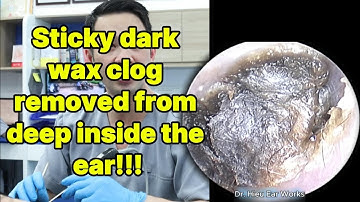 Sticky dark wax clog removed from deep inside the | ear cleaning | ASMR earwax | soothing |relax|