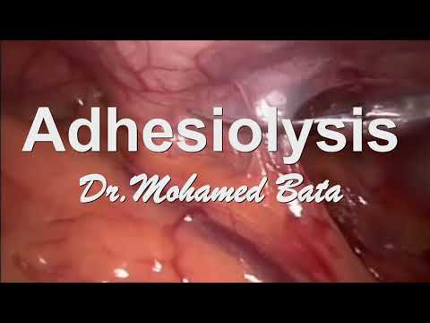 Video: Adhesiolysis Vēdera Dobuma ķirurģijas Ieguvumi, Riski Un Atveseļošanās Grafiks