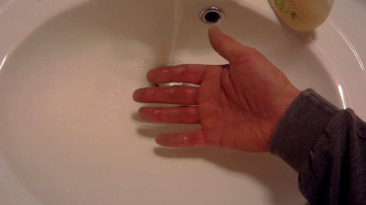 White Finger Syndrome 3 Raynaud s Phenomenon YouTube