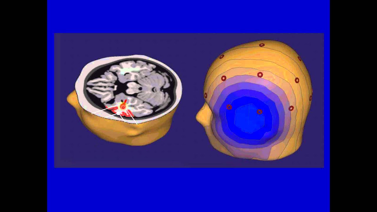 MEG and EEG Source Modeling to Localize Epileptic Foci by Dr. John S. Ebersole