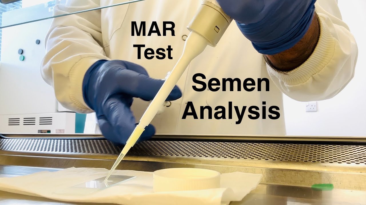 Sperm Mixed Antiglobulin Reaction (MAR) Test | Male Fertility Testing ...