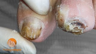 Diabetic foot [Podología Integral]