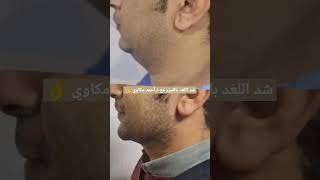 قبل وبعد شد اللغد بالفيزر مع د.أحمد مكاوي 