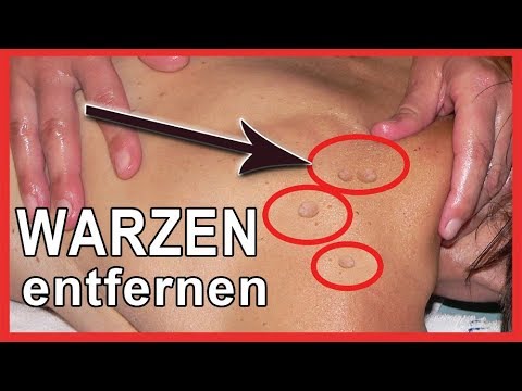 warze am rücken entfernen