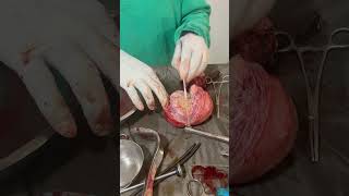 TLH for 10*10 cm fibroid