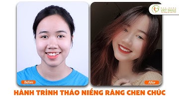 Hành trình tháo mắc cài sau 2 năm niềng răng khấp khểnh - KH Quỳnh Anh