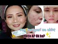 Retin a acne and photoaging treatment 3day challengewhat is tretinoinphilippines