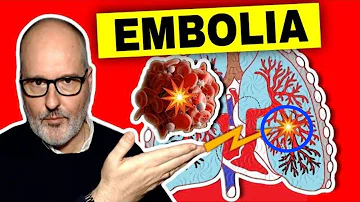 ¿Qué puede provocar una embolia pulmonar?