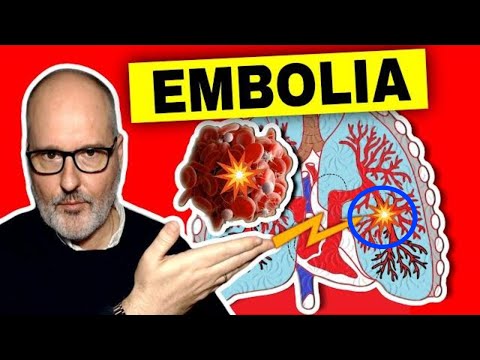 Video: ¿La embolia fibrocartilaginosa es dolorosa?