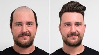 Before After Hair Replacement for Men 2019  | Transformation with Hairsystem | Hairsystems Heydecke