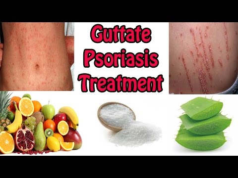 guttate-psoriasis-treatment---best-cure-for-guttate-psoriasis-with-natural-home-remedies