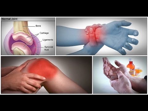 What Icd 1 Osteoarthritis