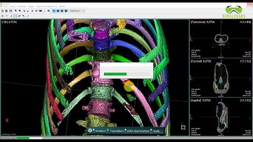 OOOPDS - Surgical planning - Spine 3