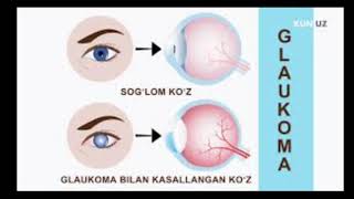 #Ko’z_kasalliklari #tabiiy_yol_bilan_davolash #kuzni_davolash #glaukoma #Ko’z_kasalliklari #tabiiy_yol_bilan_davolash #kuzni_davolash #glaukoma