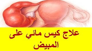 علاج كيس مائي على المبيض