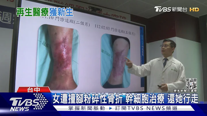 女遭撞腳粉碎性骨折 幹細胞治療 還她行走｜TVBS新聞@TVBSNEWS01 - 天天要聞