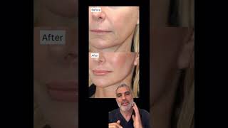 Why This Facelift Looks So Natural