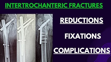 Intertrochanteric Fracture: Positioning, Entry, Reduction, Fixation & Complications (Step-by-Step)