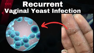 Chronic Yeast Infections | Recurrent yeast Infections - Causes, signs and symptoms Treatment