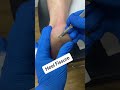 Watch and learn from our podiatrist as they demonstrate how a painful cracked heel fissure is remove