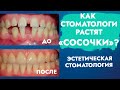 Десневые, межзубные сосочки. Эстетика в стоматологии.
