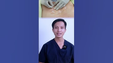 BS cấy chỉ bao nhiêu huyệt? cấy chỉ đông y, cấy chỉ xương khớp, cấy chỉ chữa thoát vị đĩa đệm