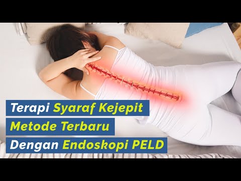 Terapi Syaraf Kejepit Di Pinggang Sembuh Cuma 45 Menit. 