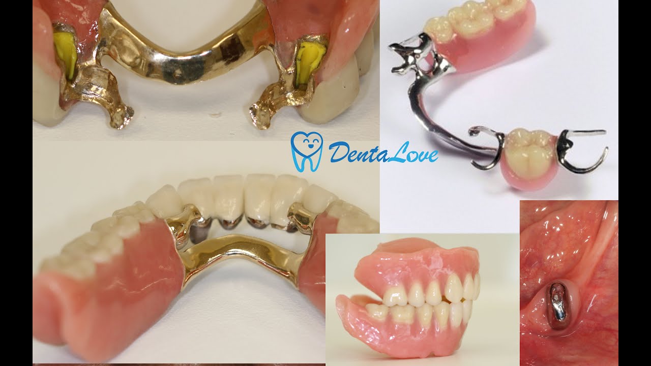 Kivehető fogpótlások