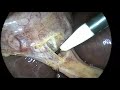 Laparoscopic cholecystectomy ,bleeding from an abnormal hepatic artery.