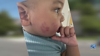 Norfolk mom removes toddler from daycare after five bite marks
