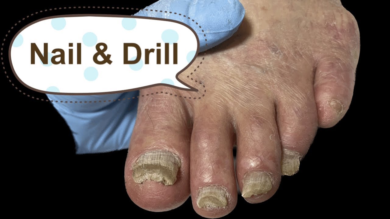 nail /toenail /nailcare /athlete’s foot /practice /nail&drill YouTube