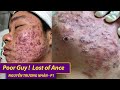 Lost of Acane| Điều trị mụn hiệu quả số 1 TPHCM | Hiền Vân spa| Nguyễn Trường Nhân | 531