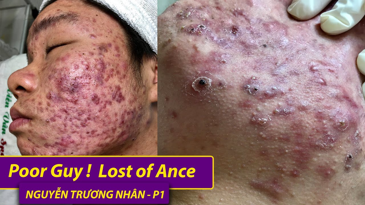 Lost of Acane| Điều trị mụn hiệu quả số 1 TPHCM | Hiền Vân spa| Nguyễn Trường Nhân | 531
