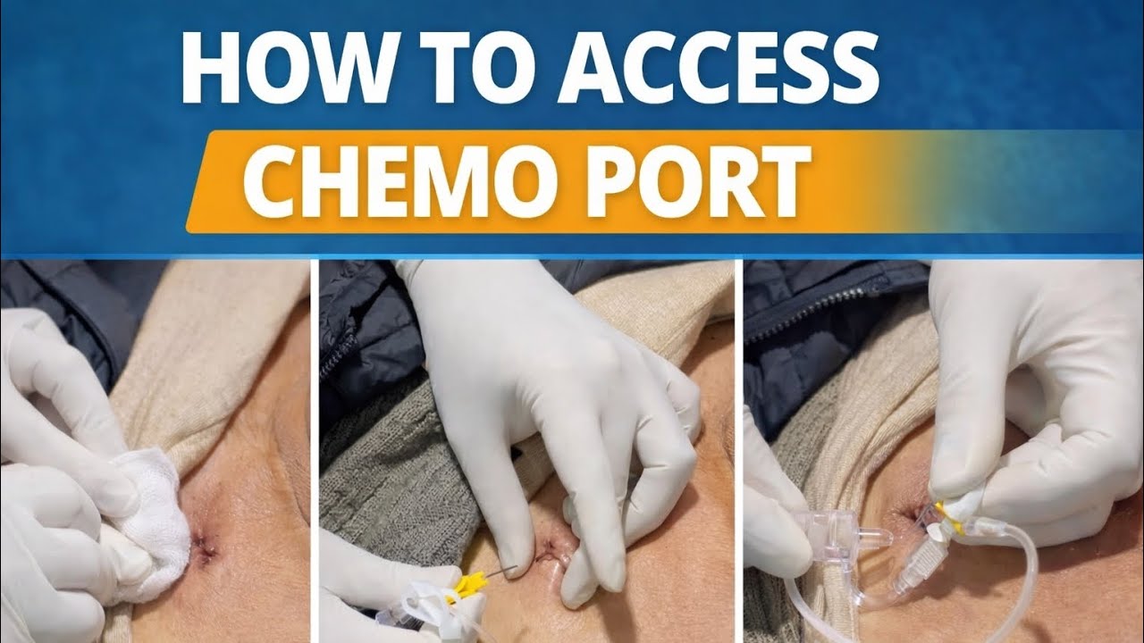 How to Access a Chemo Port | Nursing Procedure #ChemoPort#PortACath# ...
