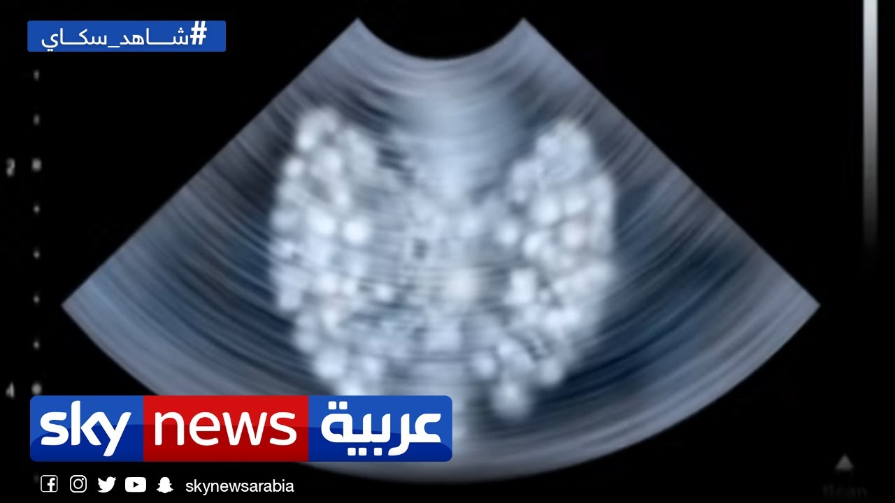 اضطرابات الغدة الدرقية وعلاقتها بتعب الإنسان