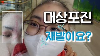 대상포진 재발이라구요? 골수이식 후 면역치료중 대상포진 재발! 입원은 이제 그만 ㅜㅜ 서울성모병원 11층 1인실!