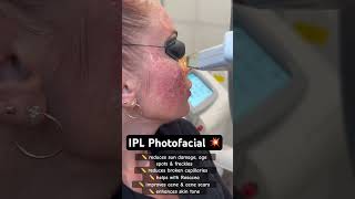 IPL Photofacial @medandspaburrridge ipl photofacial sundamage hyperpigmentation rosacea